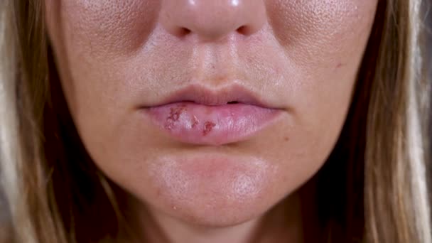 Herpes labialis virusinfektion drabbar kvinnor läpp — Stockvideo