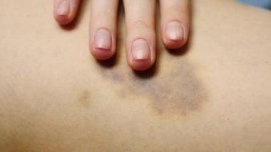 Mor Büyük Morluk ya da Hit filminden hematom.