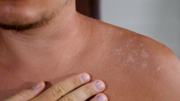 Uomo non riconosciuto toccare calore brucia la pelle sulla spalla — Video Stock