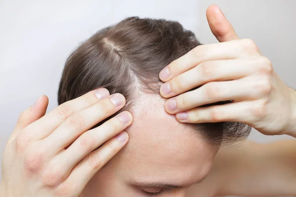 Homme Vérifie Ses Cheveux Pour Perte Concept Perte Cheveux — Photo