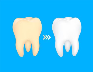 Önce ve sonra diş. Sarı beyaz, diş bakım kavramı, illüstrasyon mavi arka plan üzerinde izole olur.