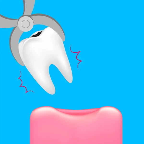 Extirpación Dientes Concepto Cuidado Dental Ilustración Aislada Sobre Fondo Azul — Archivo Imágenes Vectoriales
