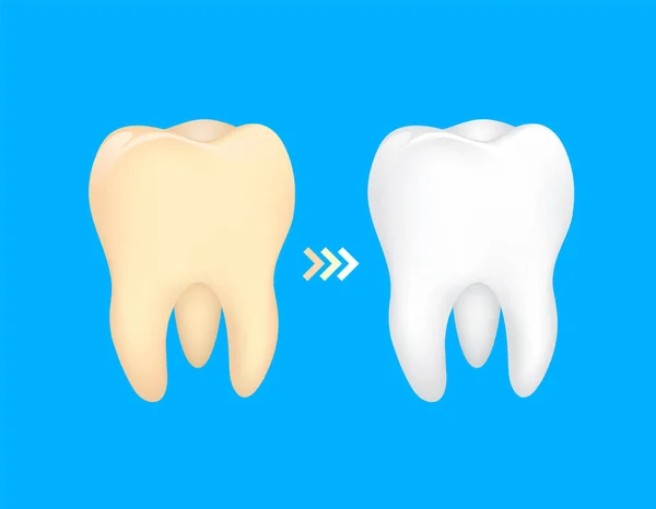 牙齿前后 黄色成为白色 牙关心概念 例证隔绝在蓝色背景上 — 图库矢量图片