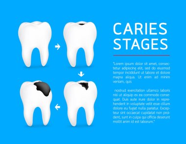 Diş çürüğü gelişim farklı aşamalarında diş. Mine çürüğü, Dentin çürük, Pulpitis ve Periodontitis. Tasarım afiş ve poster için. İllüstrasyon mavi zemin üzerine.