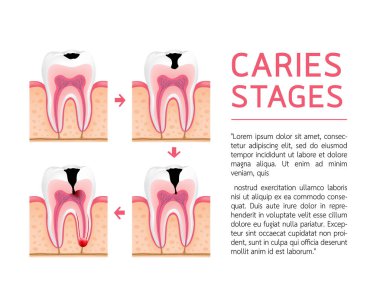 Diş çürüğü gelişim farklı aşamalarında diş. Mine çürüğü, Dentin çürük, Pulpitis ve Periodontitis. Tasarım afiş ve poster için. Resimde beyaz arka plan üzerinde.