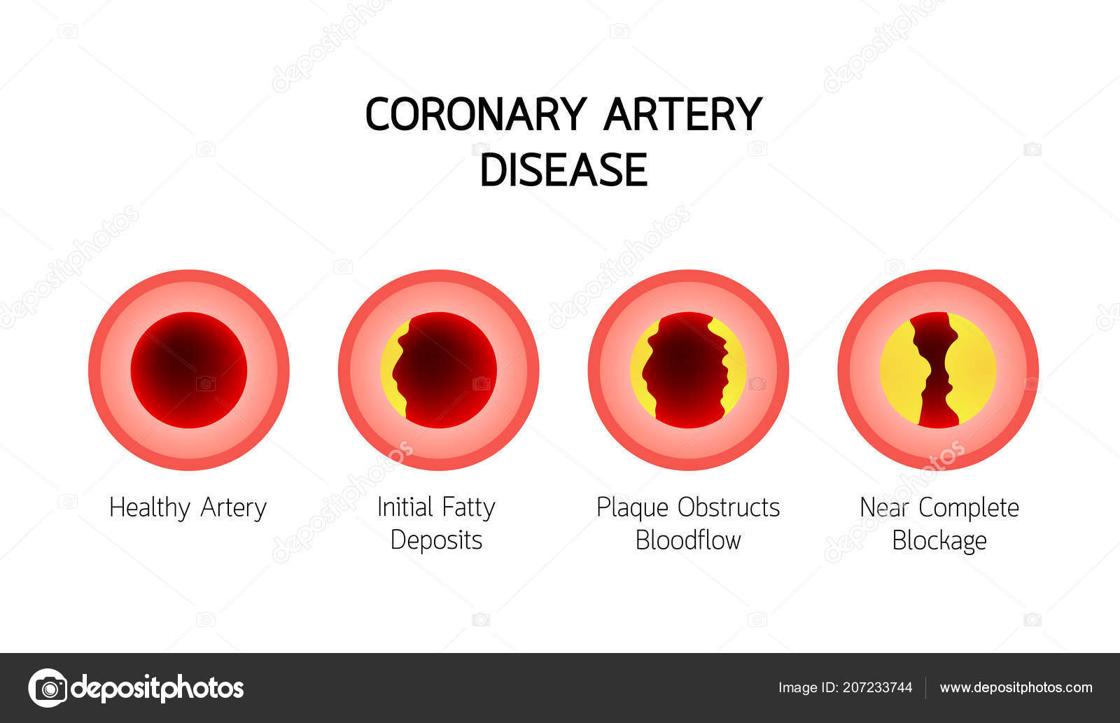 Coronary Artery Disease Infographic Heart Awareness Concept
