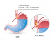 Refluxní choroba jícnu (Gerd). Kyselý reflux, pálení žáhy a gerd infografiku s žaludku lékařské ilustrace, příznaky, příčiny a prevence