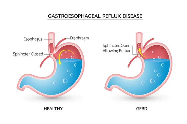 Gastroesophageal Reflux Disease Gerd Dalam Bahasa Inggris Asam Refluks Mulas - Stok Vektor