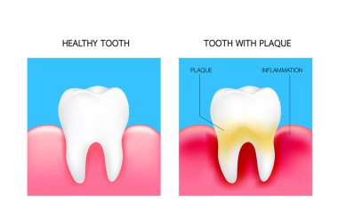 Dental plak ile inflamasyon ve sağlıklı diş. İllüstrasyon izole mavi arka plan üzerinde. Diş Bakımı kavramı.