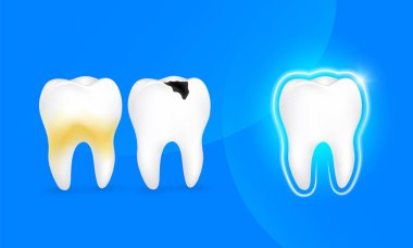 Sağlıklı diş çürüğü diş ve diş plaket. tasarımınız için harika. Diş Bakımı kavramı. İllüstrasyon izole mavi arka plan üzerinde.