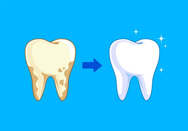 Dente Antes Depois Amarelo Torna Branco Conceito Cuidados Dentários Ilustração — Vetor de Stock