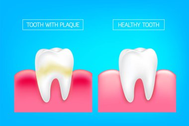 Tooth with plaque and healthy tooth comparision.  Teeth Whitening. Dental care Concept. Oral Care, teeth restoration. Yellow and white teeth. clipart