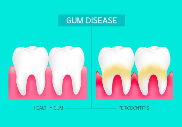 牙周炎和牙龈炎症 健康牙龈和牙周炎的比较 牙科保健的概念 绿色背景上的插图 — 图库矢量图片