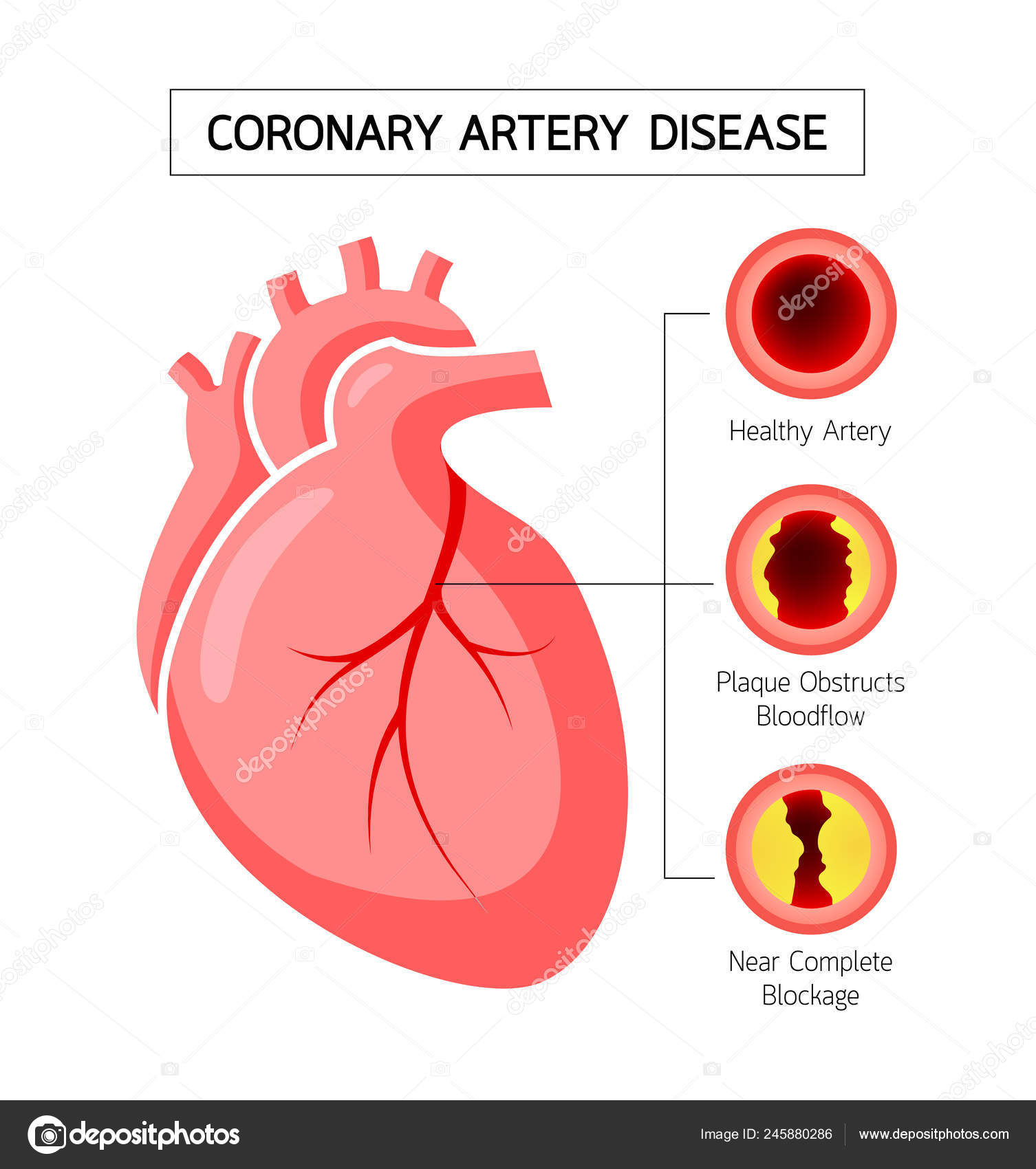 Hjerte Med Koronararteriesygdom Info Grafik Blokeret Arterie Hjerte Bevidsthed Stock Vector by ©wowow 245880286