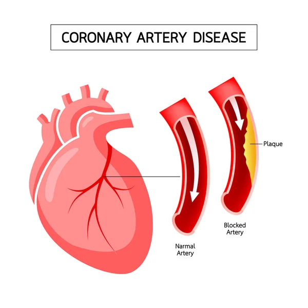 Cuore Umano Con Malattia Coronarica Info Grafico Arteria Ostruita Concetto — Vettoriale Stock