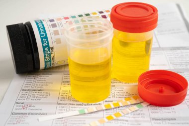 İdrar tahlili, reaksiyonlu idrar kabı. PH kağıt testi ve karşılaştırma tablosu laboratuvarda..