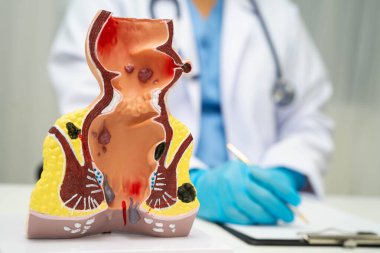 Hastanede rektum ve hemoroit insan anatomisi modeli olan Asyalı bir doktor vasküler yapısında iltihaplanma var..
