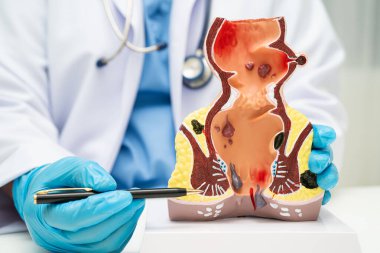 Hastanede rektum ve hemoroit insan anatomisi modeli olan Asyalı bir doktor vasküler yapısında iltihaplanma var..