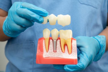 Diş implantı, çeneye yapay diş kökleri, diş tedavisinin kök kanalı, diş eti hastalığı, diş hekimliği üzerine çalışan dişçi modeli.