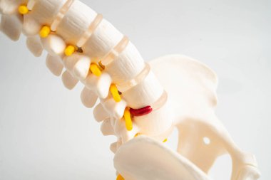 Omurga ve kemik, bel kemiği yerinden oynamış disk parçası, ortopedi bölümünde tedavi için model..