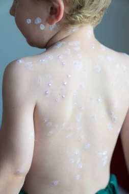 Genç sarışın çocuk sırtına suçiçeği kabarcıklar ve merhem kaplı gösterir