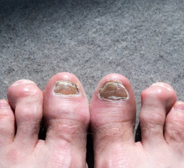 ugly male feet and toes affected by toe nail fungus and arhtriti clipart