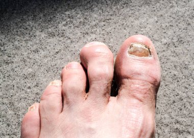 ugly male feet and toes affected by toe nail fungus and arhtriti clipart