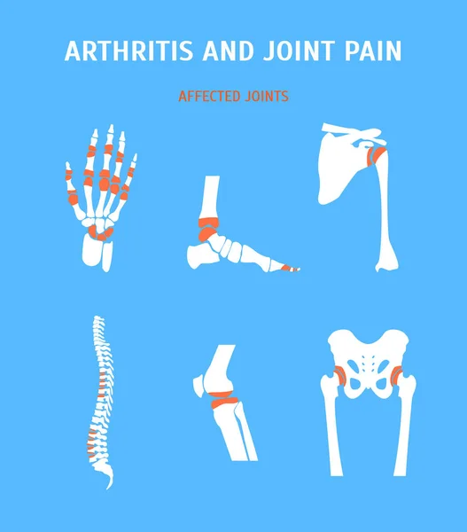 Kreslené, artritida a bolesti kloubů Set. Vektor — Stockový vektor