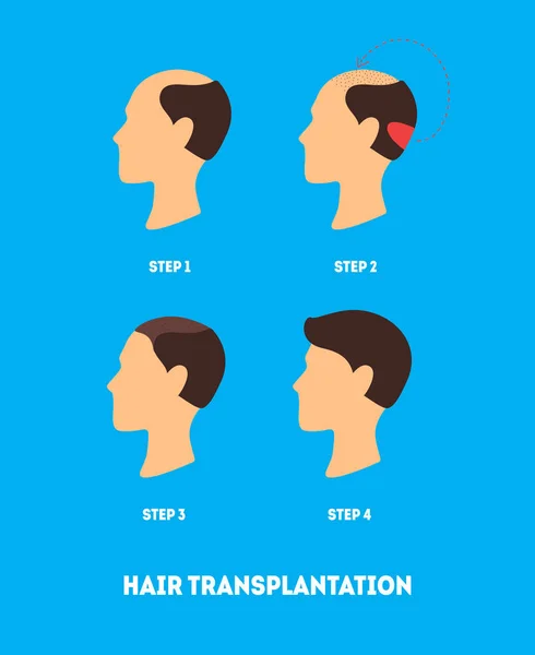 Γελοιογραφία μαλλιά μεταμόσχευση χειρουργική κάρτα αφίσα. Διάνυσμα — Διανυσματικό Αρχείο