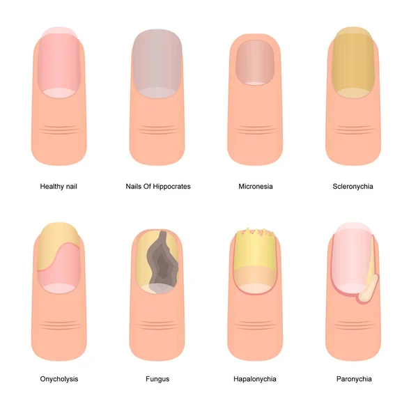 Ensemble d'icônes sur les maladies des ongles de couleur dessin animé. Vecteur — Image vectorielle