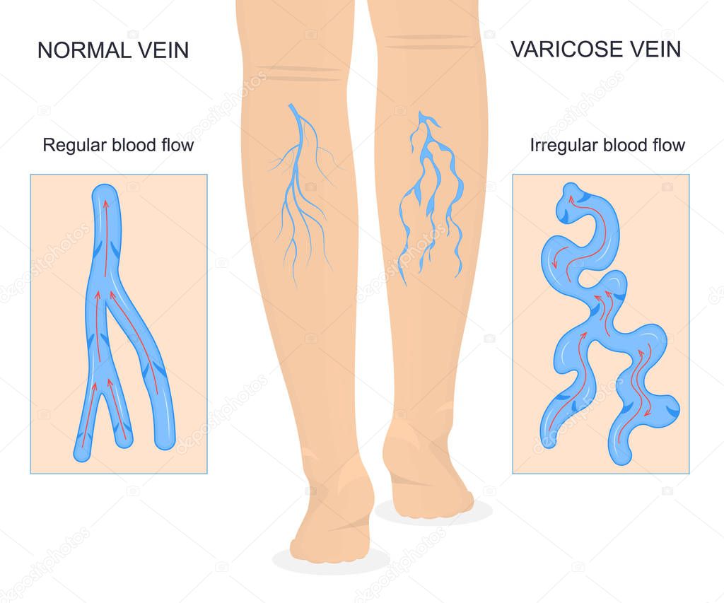 Varicose Veins Concept Banner Card with Elements. Vector