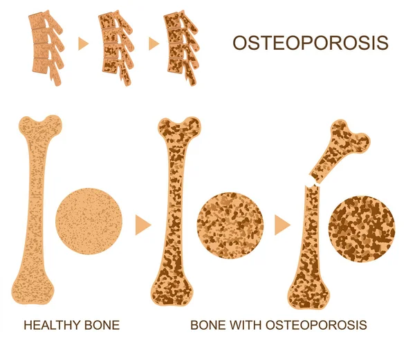 Osteoporóza Kostní Infographics Koncept Karta Plakát. Vektor — Stockový vektor