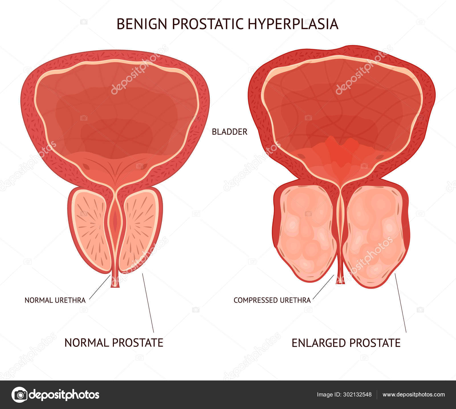 mi a prostatitis hiperplázia)