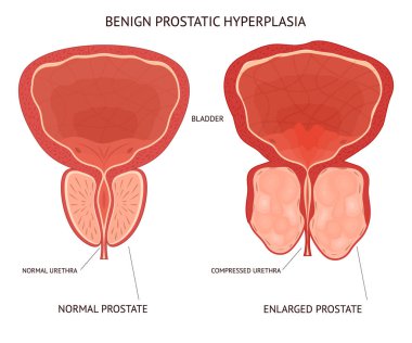 Cartoon Benign Prostatic Hyperplasia Infographics Concept Card Poster. Vector clipart