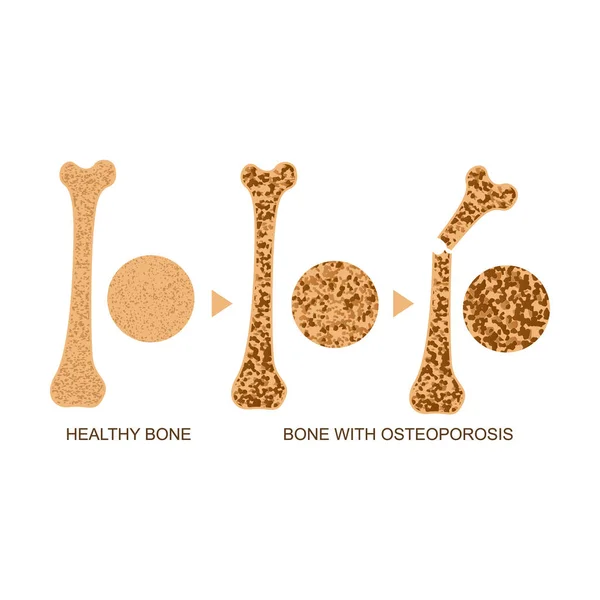 Osteoporosis Bone Infographics Koncepció Kártya poszter. Vektor — Stock Vector