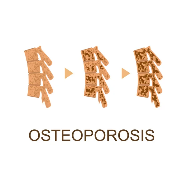 Osteoporosi Infografica ossea Concept Card Poster. Vettore — Vettoriale Stock