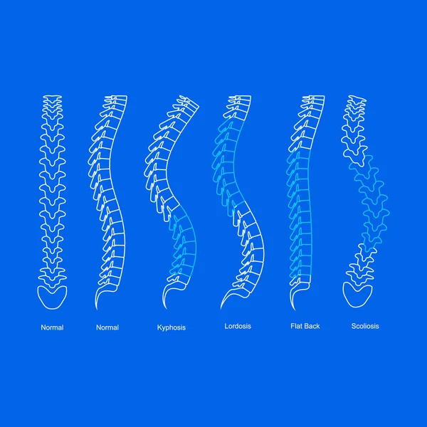 Osteoporosis Bone Types Infographics Concept Card Poster Contour Linear Style. Vector — 스톡 벡터