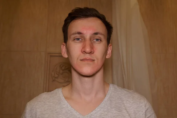 Genç bir adamın alerjik reaksiyon sonra kırmızı yüz.