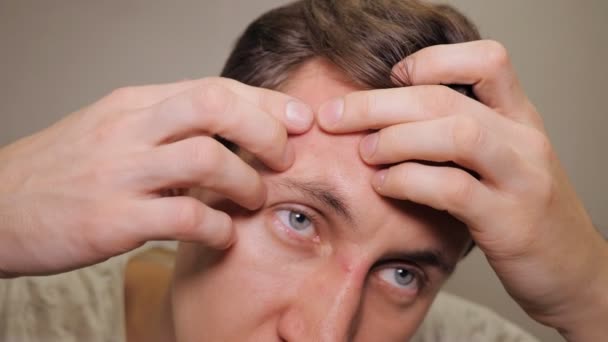 Young man squeezing a pimple — Stock Video