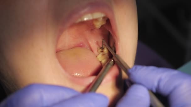 Dentist examines patients tooth with black cavity on it using dental tools and mirror. Tooth decay closeup.