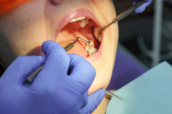 Dentist examines patients tooth with black cavity on it using dental tools and mirror. Tooth decay closeup.