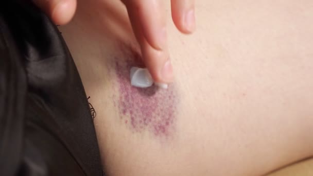 Young woman applies white cream on purple thigh bruise — Stock Video