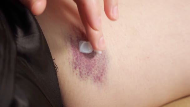 Giovane donna applica crema bianca sul livido viola della coscia — Video Stock