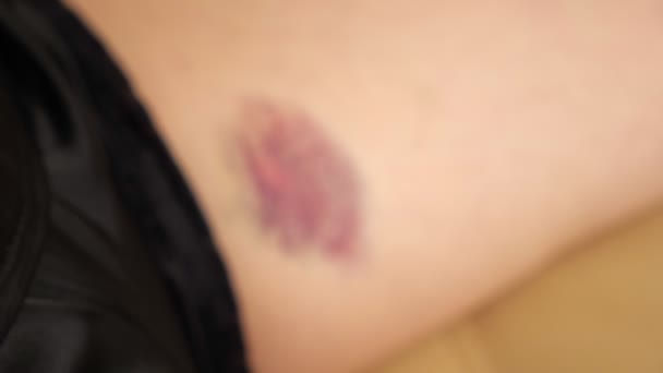 Close-up of blue and pink bruise on womans thigh — Stock Video
