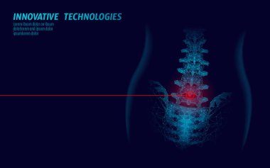Lazer fizyoterapi insan omurga. Ağrı alan cerrahi operasyon modern tıp teknolojisi düşük poli üçgenler 3d render kadın sırt fıtığı vektör çizim