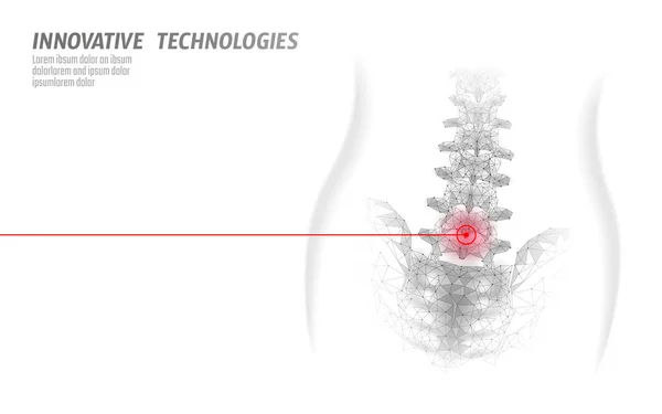 Fisioterapia láser espina dorsal humana. Operación de cirugía del área del dolor tecnología de medicina moderna triángulos polivinílicos bajos 3D renderizar la espalda femenina hernia vector ilustración — Vector de stock