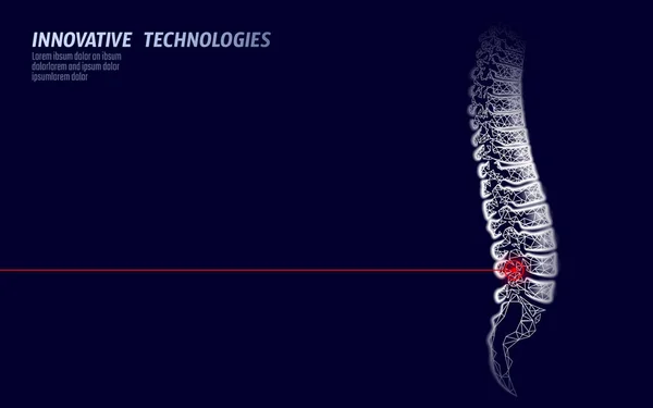 Fisioterapia láser lesión en la columna vertebral humana. Operación de cirugía del área del dolor moderna tecnología de medicina de lomo triángulos polivinílicos bajos 3D renderizar la espalda femenina hernia vector ilustración — Vector de stock