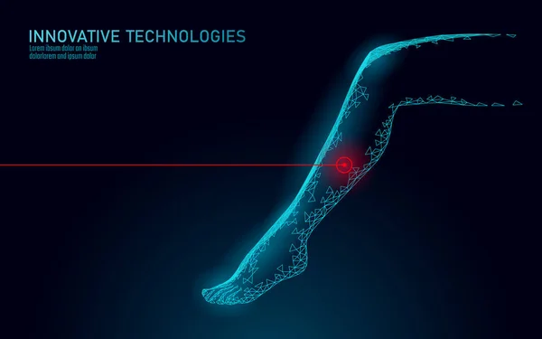 3d kadın bacak endovenöz lazer operasyonu kavramı. Tıbbi cerrahi damarlar varis tedavisi kadın ayak. Kozmetik saç lazer depilasyon sağlıklı masaj salonu bakım vektör illüstrasyon