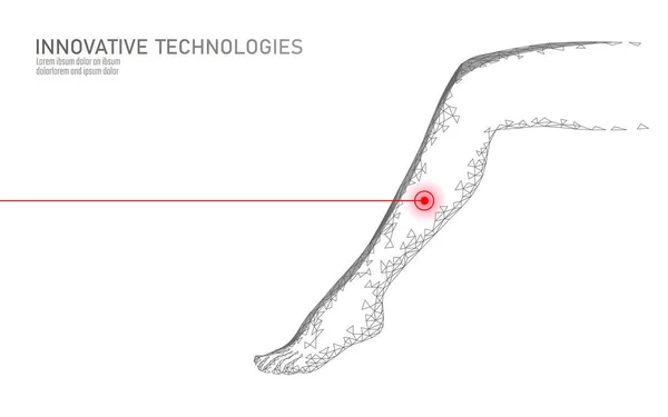 3D Kobieta nogi Endożylna koagulacja Laser Operation koncepcji. Chirurgia medyczna żył żylaki leczenie stóp. Kosmetyczne Depilacja Laser ilustracja masaż Pielęgnacja salon wektor zdrowy — Wektor stockowy