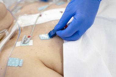 Küresel eldivenli el, yoğun bakımdaki ağır hasta bir hastaya EKG elektrodu ayarlıyor.